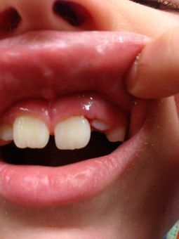 teeth-654457__340